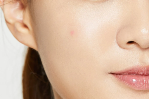 ACNE PIMPLE MASTER 24 PATCHES - Imagen 3